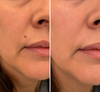 ✨ PURESHADE® 2v1 mikrojehličková + hydrokoloidní náplast🍀 | Pomáhá odstraňovat vystouplá znaménka, akné, ploché bradavice a kožní výrůstky | Pomáhá zjemnit vrásky, jizvy a nedokonalosti pleti | Diskrétní neviditelná náplast pro obličej i tělo