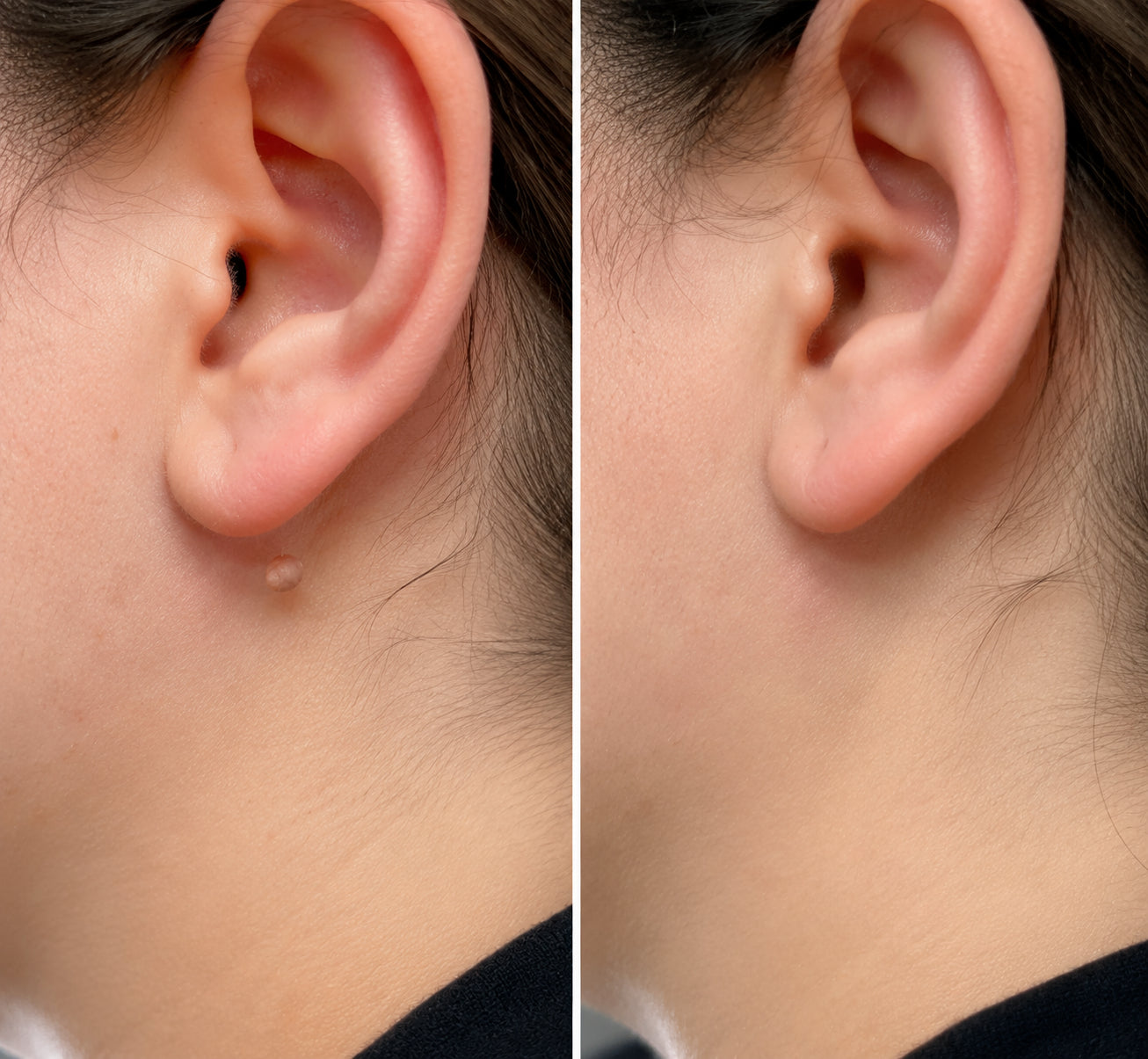 ✨ PURESHADE® 2v1 mikrojehličková + hydrokoloidní náplast🍀 | Pomáhá odstraňovat vystouplá znaménka, akné, ploché bradavice a kožní výrůstky | Pomáhá zjemnit vrásky, jizvy a nedokonalosti pleti | Diskrétní neviditelná náplast pro obličej i tělo