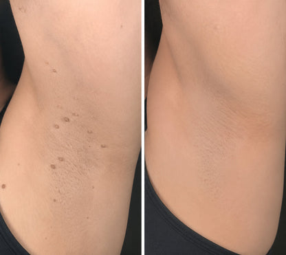 ✨ PURESHADE® 2v1 mikrojehličková + hydrokoloidní náplast🍀 | Pomáhá odstraňovat vystouplá znaménka, akné, ploché bradavice a kožní výrůstky | Pomáhá zjemnit vrásky, jizvy a nedokonalosti pleti | Diskrétní neviditelná náplast pro obličej i tělo