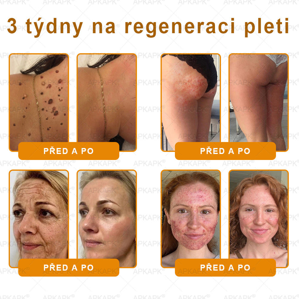 🔥  Dermatologicky a klinicky testováno🐝APKAPK®Bee Venom Krém na obnovení pleti🐝 pomáhá při léčbě kožních problémů, jako jsou: vrásky, jizvy, pigmentové skvrny, strie, akné, psoriáza, ekzém, kožní změny, podráždění, záněty a další kožní problémy.