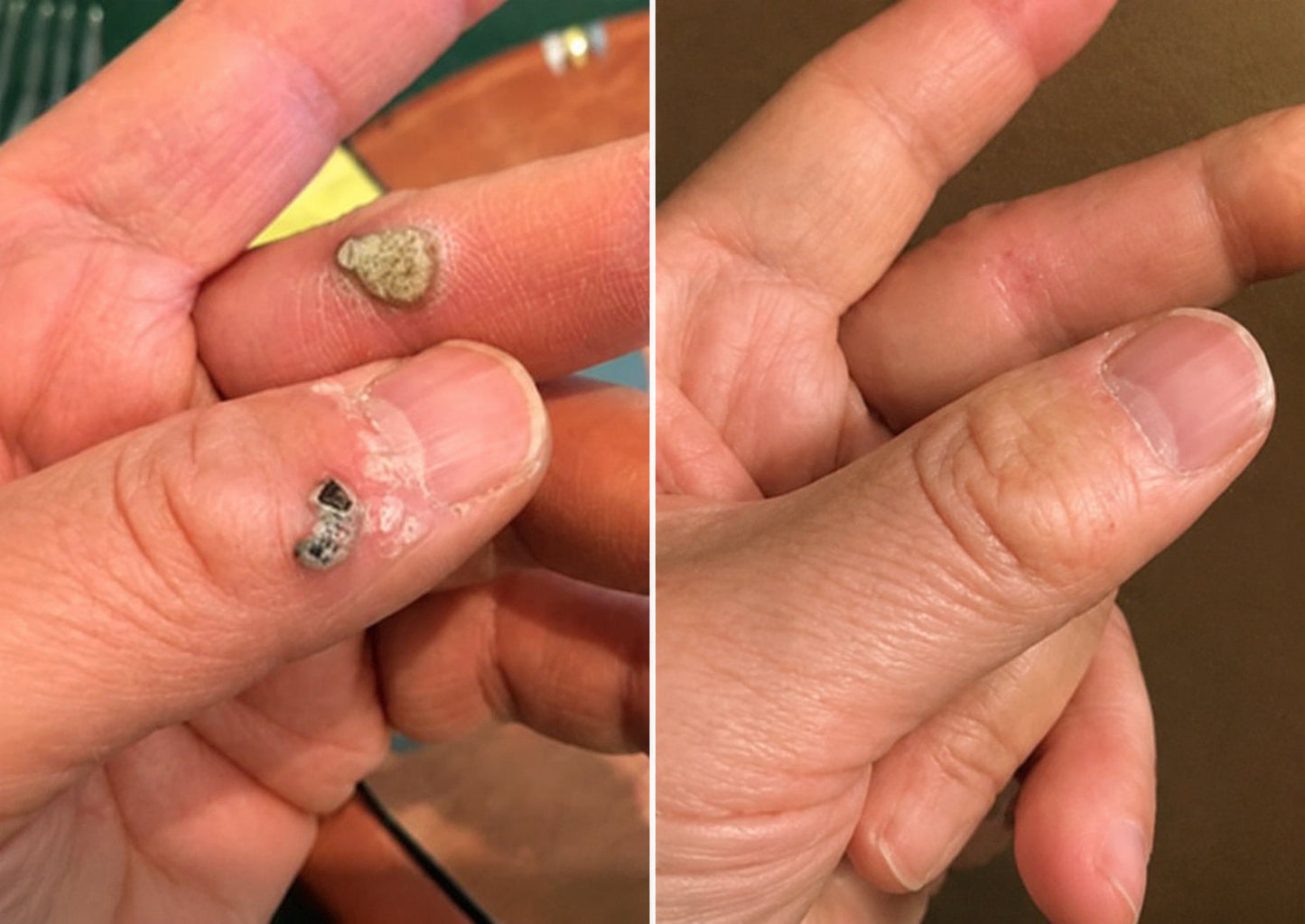 ✨ PURESHADE® 2v1 mikrojehličková + hydrokoloidní náplast🍀 | Pomáhá odstraňovat vystouplá znaménka, akné, ploché bradavice a kožní výrůstky | Pomáhá zjemnit vrásky, jizvy a nedokonalosti pleti | Diskrétní neviditelná náplast pro obličej i tělo