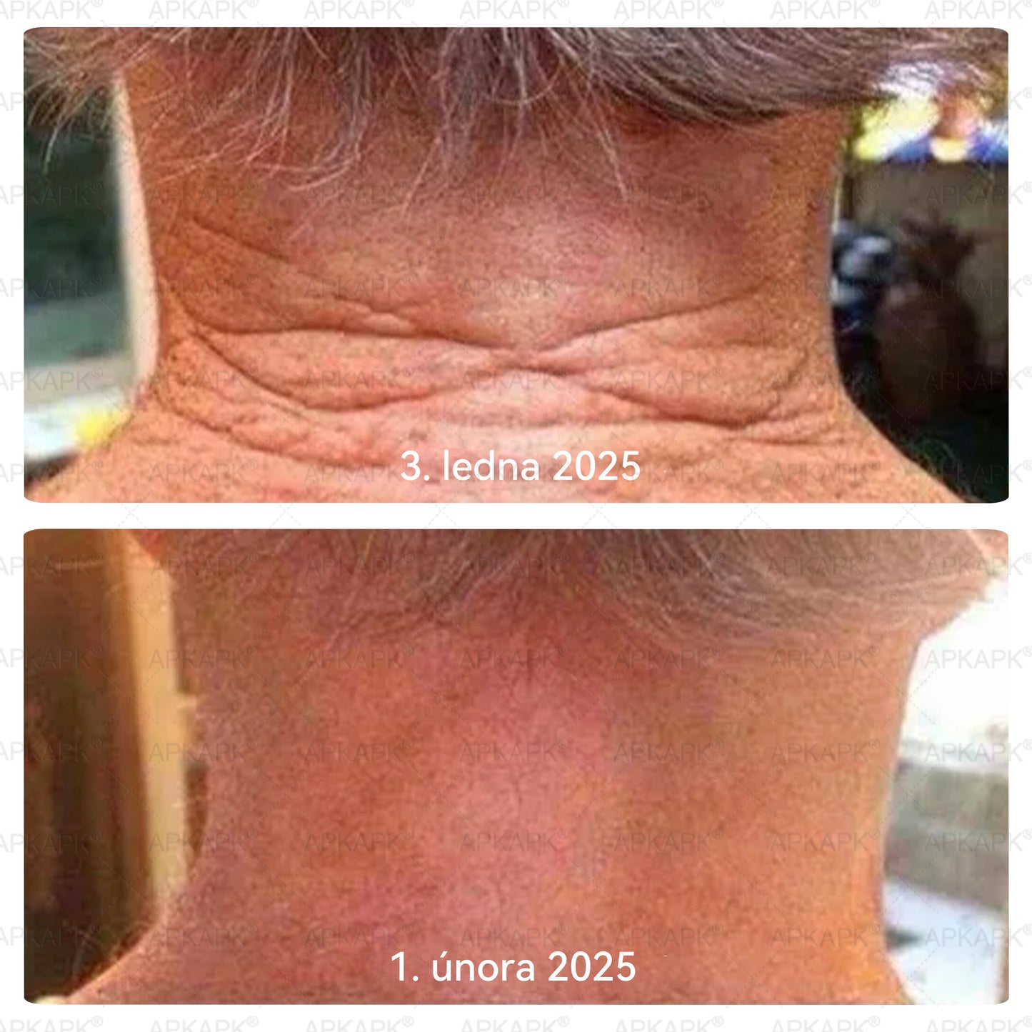 𝖠𝖯𝖪𝖠𝖯𝖪® 🐝 🐝Krém s včelím jedem na obnovu pokožky 🐝 pomáhá při řešení kožních problémů, jako jsou: vrásky, jizvy, pigmentové skvrny, strie, akné, lupénka, ekzém, kožní léze, podráždění, záněty a další kožní potíže.