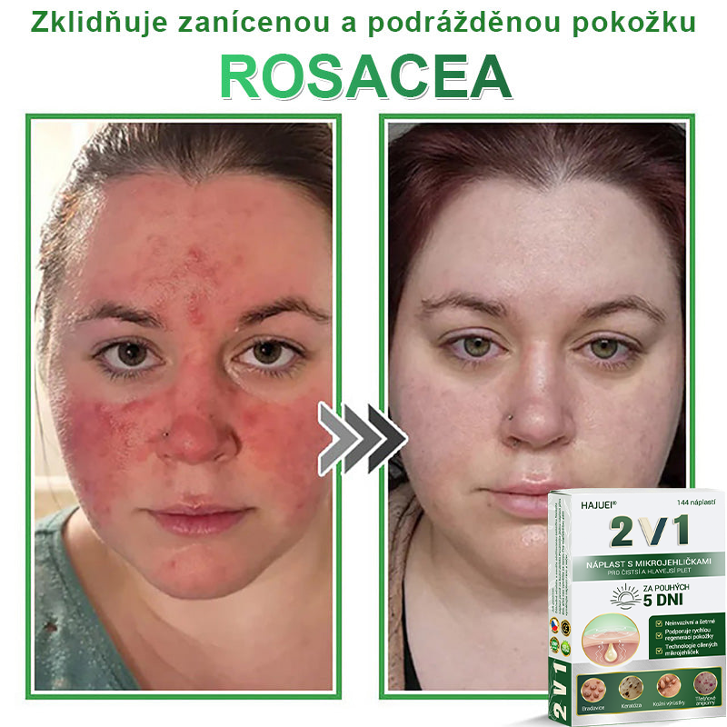 HAJUEI® 📌📌📌 𝟐𝐯𝟏 𝐡𝐲𝐝𝐫𝐨𝐤𝐨𝐥𝐨𝐢𝐝𝐧í 𝐧á𝐩𝐥𝐚𝐬𝐭𝐢 𝐬 𝐦𝐢𝐤𝐫𝐨𝐣𝐞𝐡𝐥𝐢č𝐤𝐚𝐦𝐢 | 𝐒𝐩𝐞𝐜𝐢á𝐥𝐧ě 𝐯𝐲𝐯𝐢𝐧𝐮𝐭é 𝐩𝐫𝐨 𝐨𝐝𝐬𝐭𝐫𝐚𝐧ě𝐧í 𝐯𝐲𝐬𝐭𝐨𝐮𝐩𝐥ý𝐜𝐡 𝐦𝐚𝐭𝐞ř𝐬𝐤ý𝐜𝐡 𝐳𝐧𝐚𝐦é𝐧𝐞𝐤, 𝐚𝐤𝐧é, 𝐩𝐥𝐨𝐜𝐡ý𝐜𝐡 𝐛𝐫𝐚𝐝𝐚𝐯𝐢𝐜 𝐚 𝐤𝐨ž𝐧í𝐜𝐡 𝐯ý𝐫ů𝐬𝐭𝐤ů | 𝐁𝐚𝐥𝐞𝐧í 𝟏𝟒𝟒 𝐤𝐮𝐬ů🌵🌵