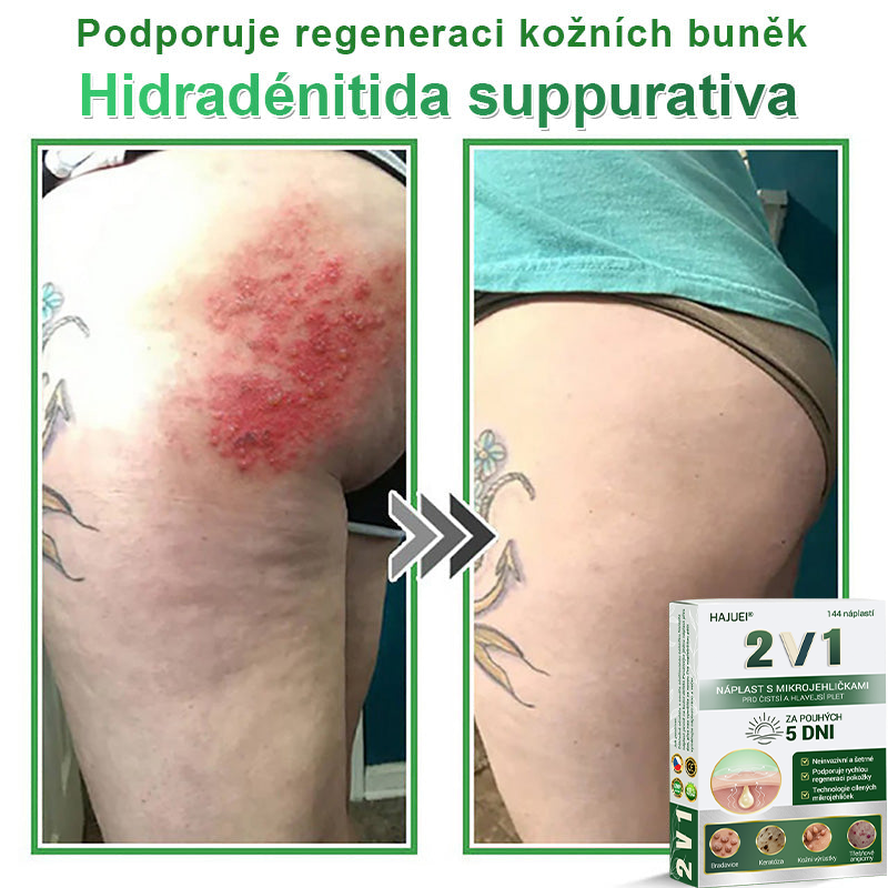 HAJUEI® 📌📌📌 𝟐𝐯𝟏 𝐡𝐲𝐝𝐫𝐨𝐤𝐨𝐥𝐨𝐢𝐝𝐧í 𝐧á𝐩𝐥𝐚𝐬𝐭𝐢 𝐬 𝐦𝐢𝐤𝐫𝐨𝐣𝐞𝐡𝐥𝐢č𝐤𝐚𝐦𝐢 | 𝐒𝐩𝐞𝐜𝐢á𝐥𝐧ě 𝐯𝐲𝐯𝐢𝐧𝐮𝐭é 𝐩𝐫𝐨 𝐨𝐝𝐬𝐭𝐫𝐚𝐧ě𝐧í 𝐯𝐲𝐬𝐭𝐨𝐮𝐩𝐥ý𝐜𝐡 𝐦𝐚𝐭𝐞ř𝐬𝐤ý𝐜𝐡 𝐳𝐧𝐚𝐦é𝐧𝐞𝐤, 𝐚𝐤𝐧é, 𝐩𝐥𝐨𝐜𝐡ý𝐜𝐡 𝐛𝐫𝐚𝐝𝐚𝐯𝐢𝐜 𝐚 𝐤𝐨ž𝐧í𝐜𝐡 𝐯ý𝐫ů𝐬𝐭𝐤ů | 𝐁𝐚𝐥𝐞𝐧í 𝟏𝟒𝟒 𝐤𝐮𝐬ů🌵🌵