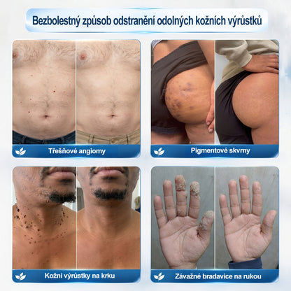 🐬🧪Oficiální značkový obchod | Hiskin® 7denní odstraňovač skvrn a pigmentových skvrn (Bezbolestný rollerball bez jizev)