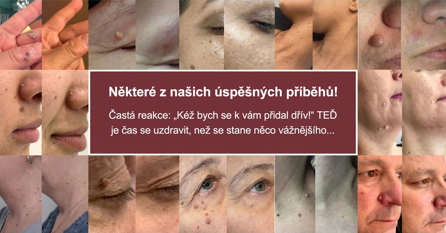 ✨ PURESHADE® 2v1 mikrojehličková + hydrokoloidní náplast🍀 | Pomáhá odstraňovat vystouplá znaménka, akné, ploché bradavice a kožní výrůstky | Pomáhá zjemnit vrásky, jizvy a nedokonalosti pleti | Diskrétní neviditelná náplast pro obličej i tělo