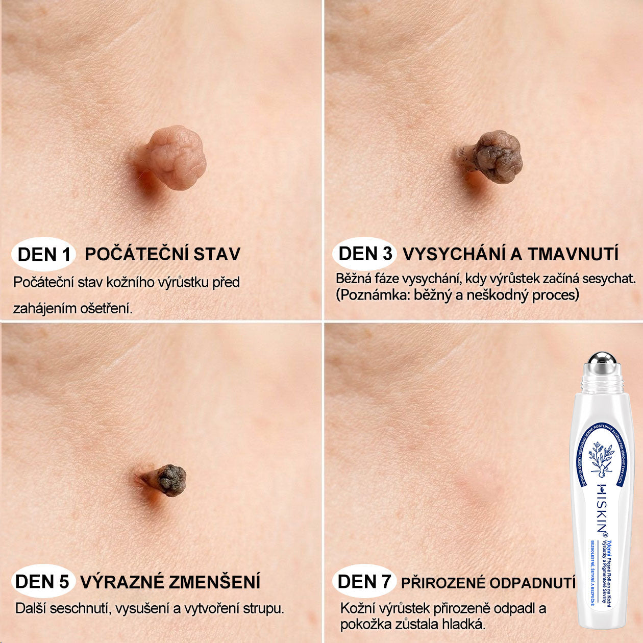 🐬🧪Oficiální značkový obchod | Hiskin® 7denní odstraňovač skvrn a pigmentových skvrn (Bezbolestný rollerball bez jizev)